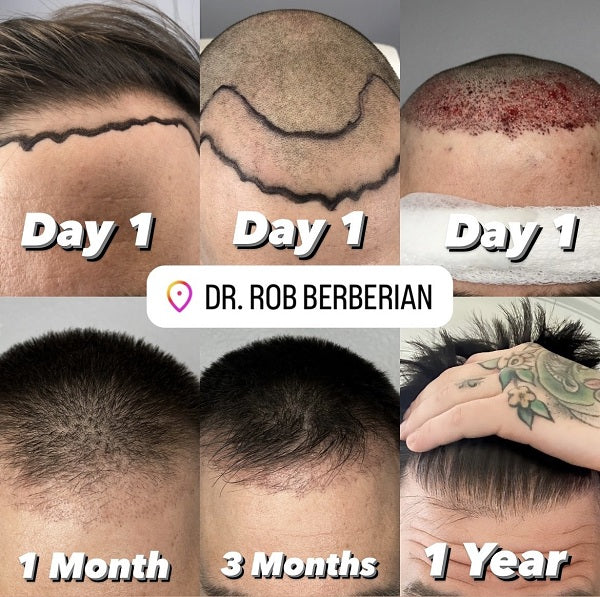 Exosome Hair Restoration: The secret of celebrity hair regrowth