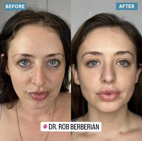 Celebrity Facial Sculpting Secrets are revealed by Dr. Rob Berberian