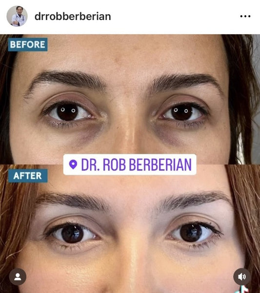 Dr. Rob Berberian - Celebrity Under Eye Treatment Before & After