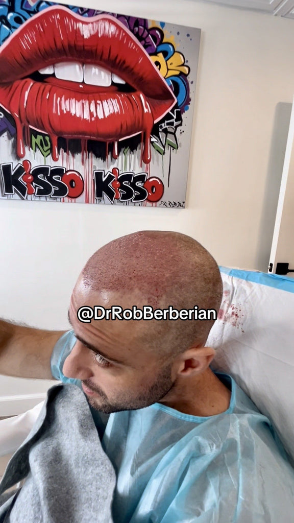 FUE Hair Transplant Timeline and Progress with Photos