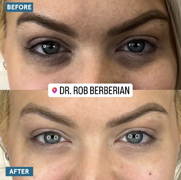 Revealing Celebrity Under Eye Filler Secrets