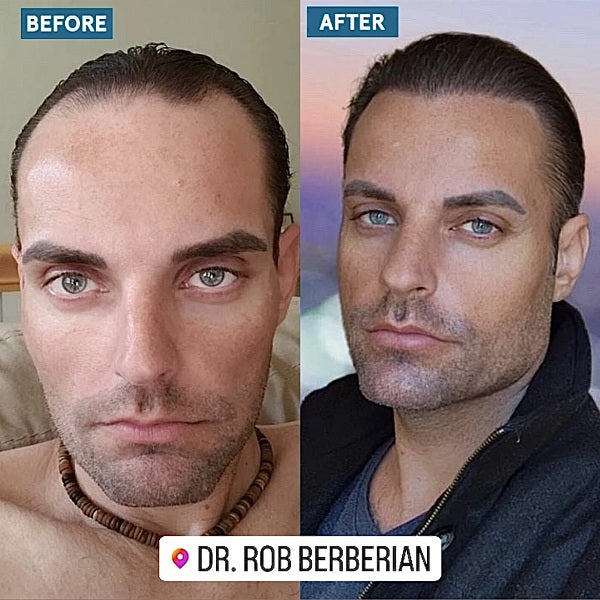 Actor Christian Cage Gets a Hair Transplant by Celebrity Hair Transplant Surgeon Dr. Rob Berberian in Los Angeles & Newport Beach California