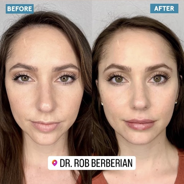 Secret Cosmetic Treatments of Celebrities: How Celebs Change the Shape of their Faces Without Surgery