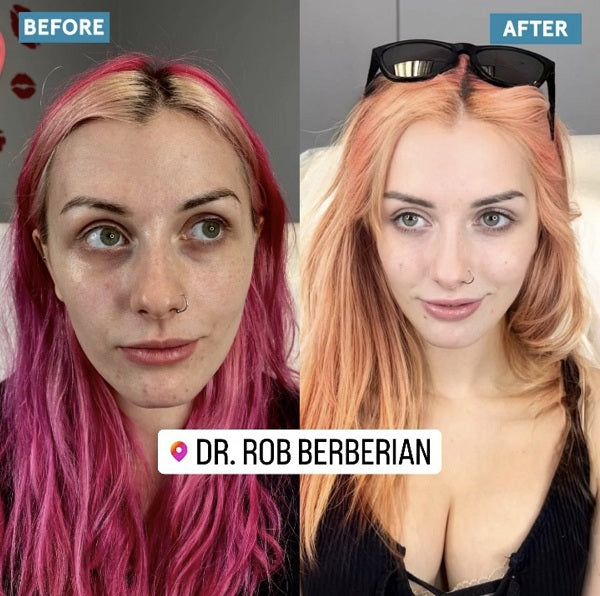 The Art of Dermal Fillers by Dr. Rob Berberian at Kisso Kisso Med Spa in Newport Beach