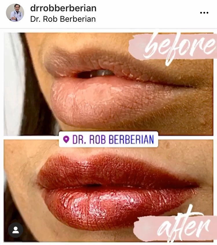 Zero Bruising Lip Filler Technique Created by Dr. Rob Berberian in Newport Beach