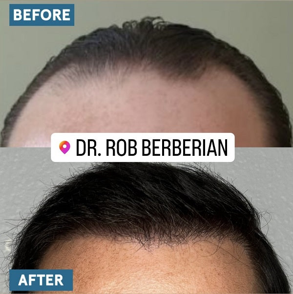Hair Transplant Timeline: How is my hair supposed to look at 1 month, 3 months, 6 months, 1 year