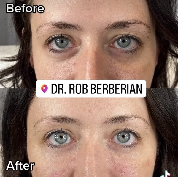 Dr. Rob Berberian - Celebrity Under Eye Treatment Before & After