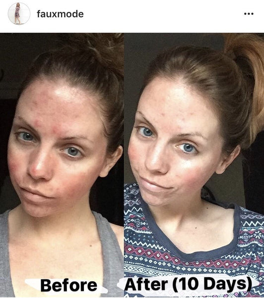 Secret in-a-Tube Simple Blemish Treatment
